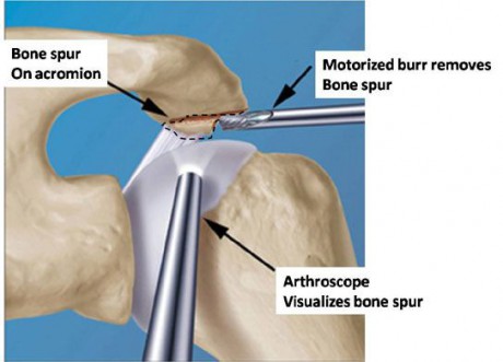 Akromioplastika.jpg