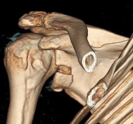 3D CT ramena