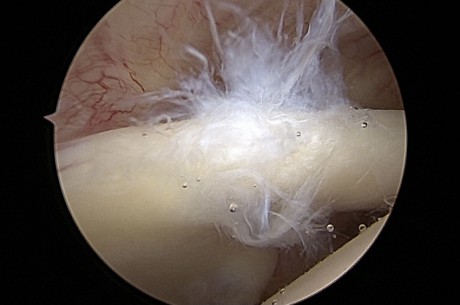 natržená šlacha bicepsu